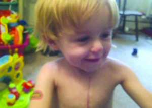 Joshua has had nine surgeries including three open heart surgeries. 